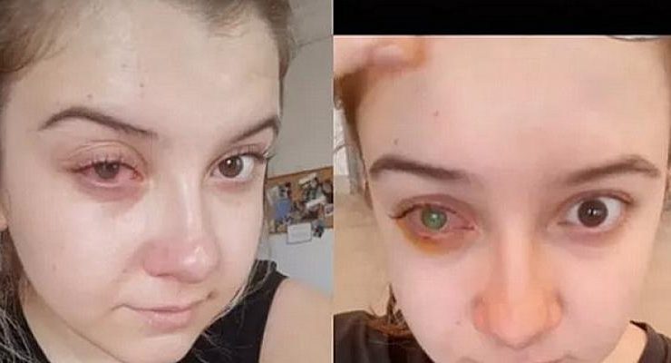 Bilinçsiz kontakt lens kullanımı göz kaybına neden olabilir