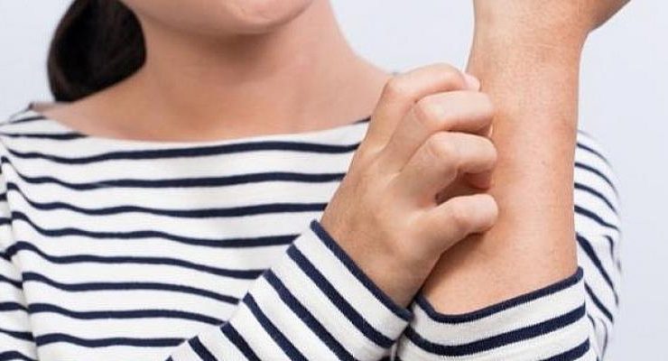 Kaşıntı Neden Olur Kaşıntıya Ne İyi Gelir