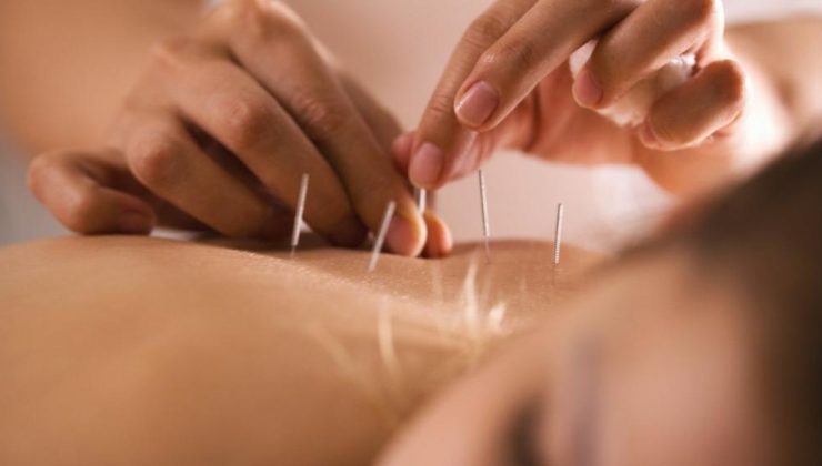 Akupunkturun gebe bayanlarda ağrıyı azalttığı bulundu