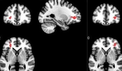 Covid-19 geçirenlerin beyinlerini incelediler: Kaygı yaratan sonuç