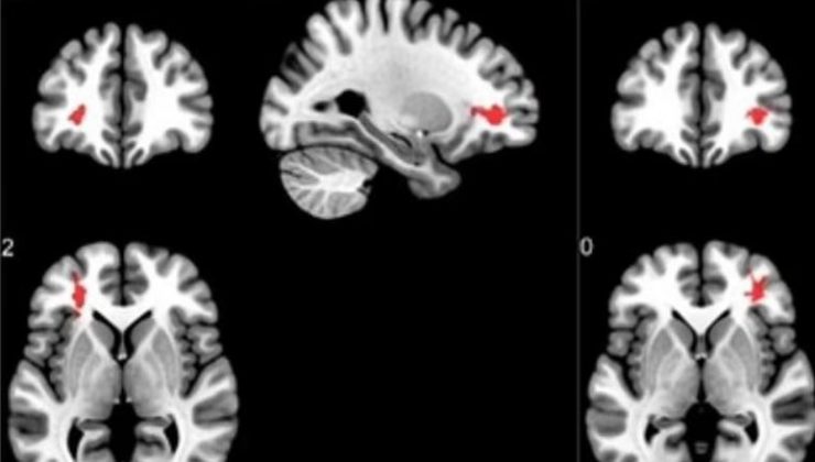 Covid-19 geçirenlerin beyinlerini incelediler: Kaygı yaratan sonuç
