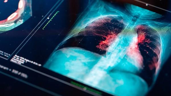İhtilal niteliğindeki robotik teknoloji, akciğer kanserini hem tedavi ediyor hem de önleyebiliyor