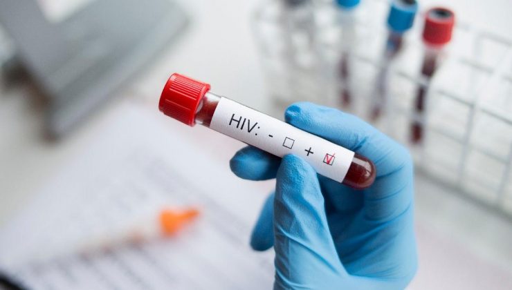 Türkiye’de kaç kişinin HIV virüsü taşıdığı açıklandı