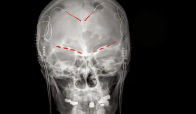Araştırma: Beyindeki kronik ağrıyı tespit edebilen algoritma geliştirildi
