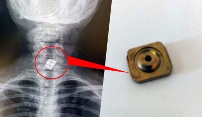 Doktorlar şaşkına döndü! Boynunda olması gereken implant bakın nereden çıktı
