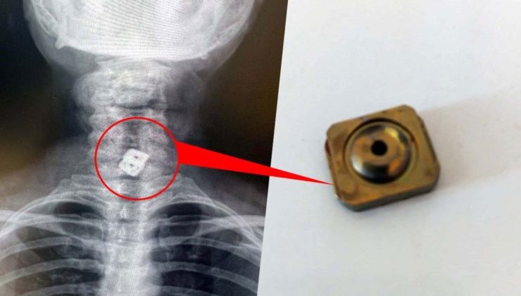 Doktorlar şaşkına döndü! Boynunda olması gereken implant bakın nereden çıktı