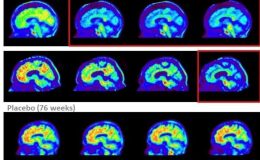 Alzheimer hastalığında yeni umut: Hastalığı yavaşlatmayı başardılar